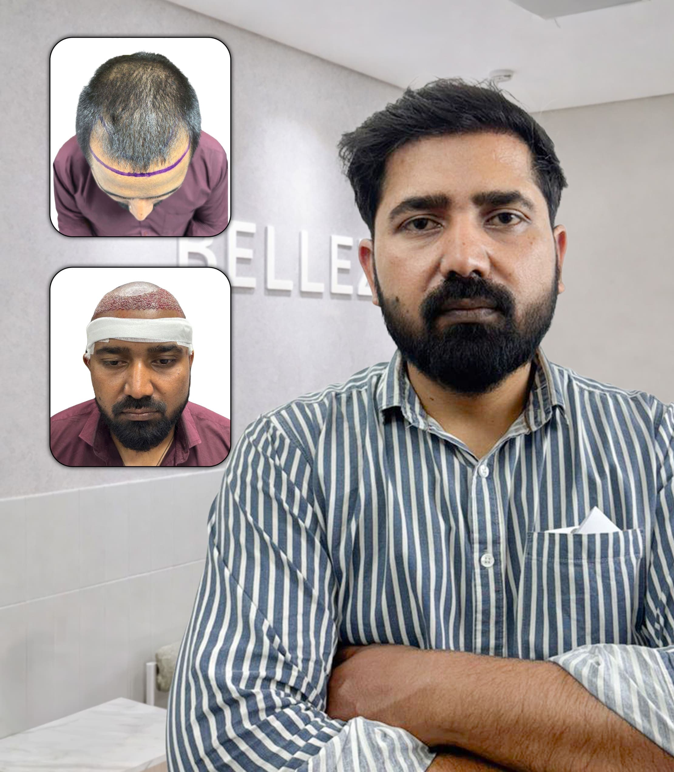 Natural Hairline Restoration with Dense Frontal Coverage