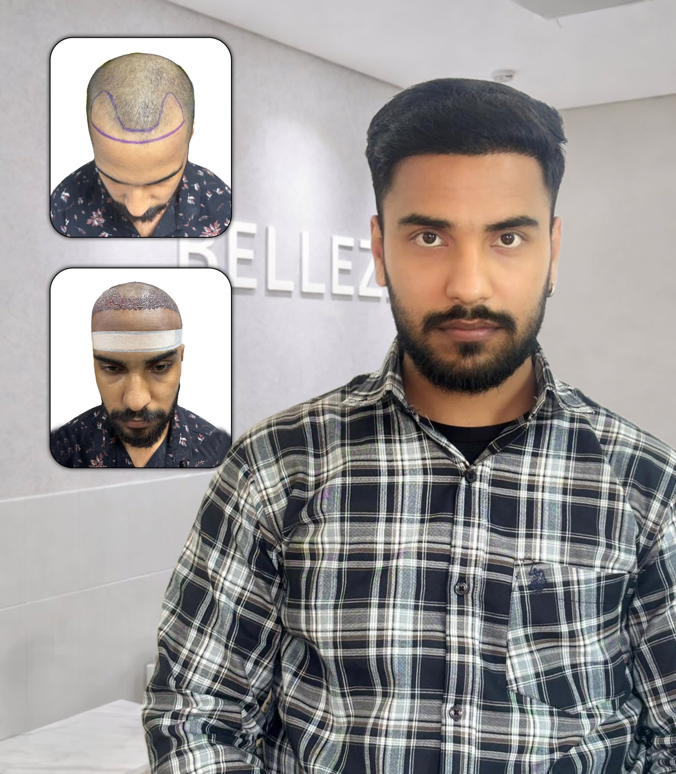 Natural Hairline Comeback with Enhanced Density