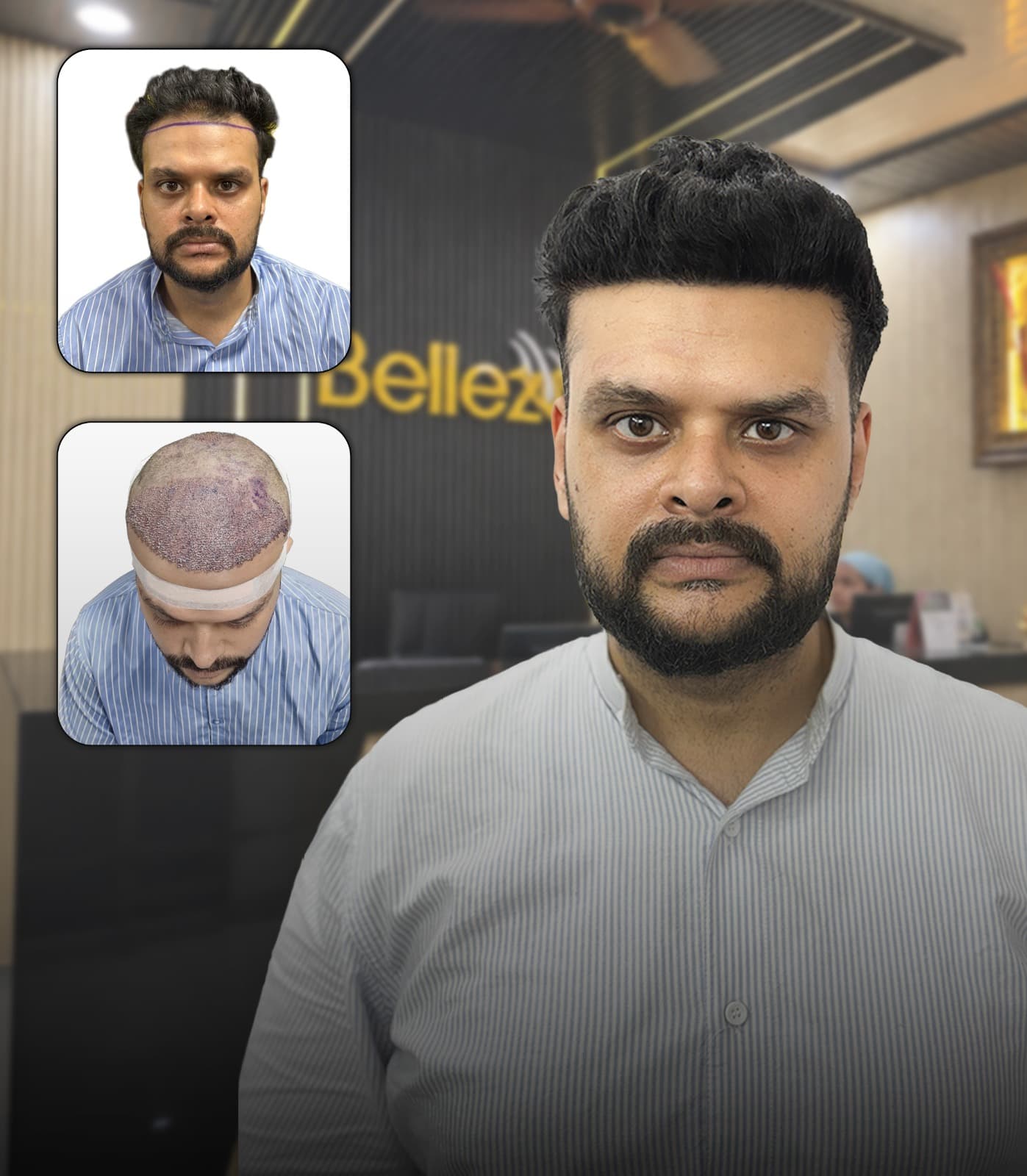 Hair Transplant Transformation