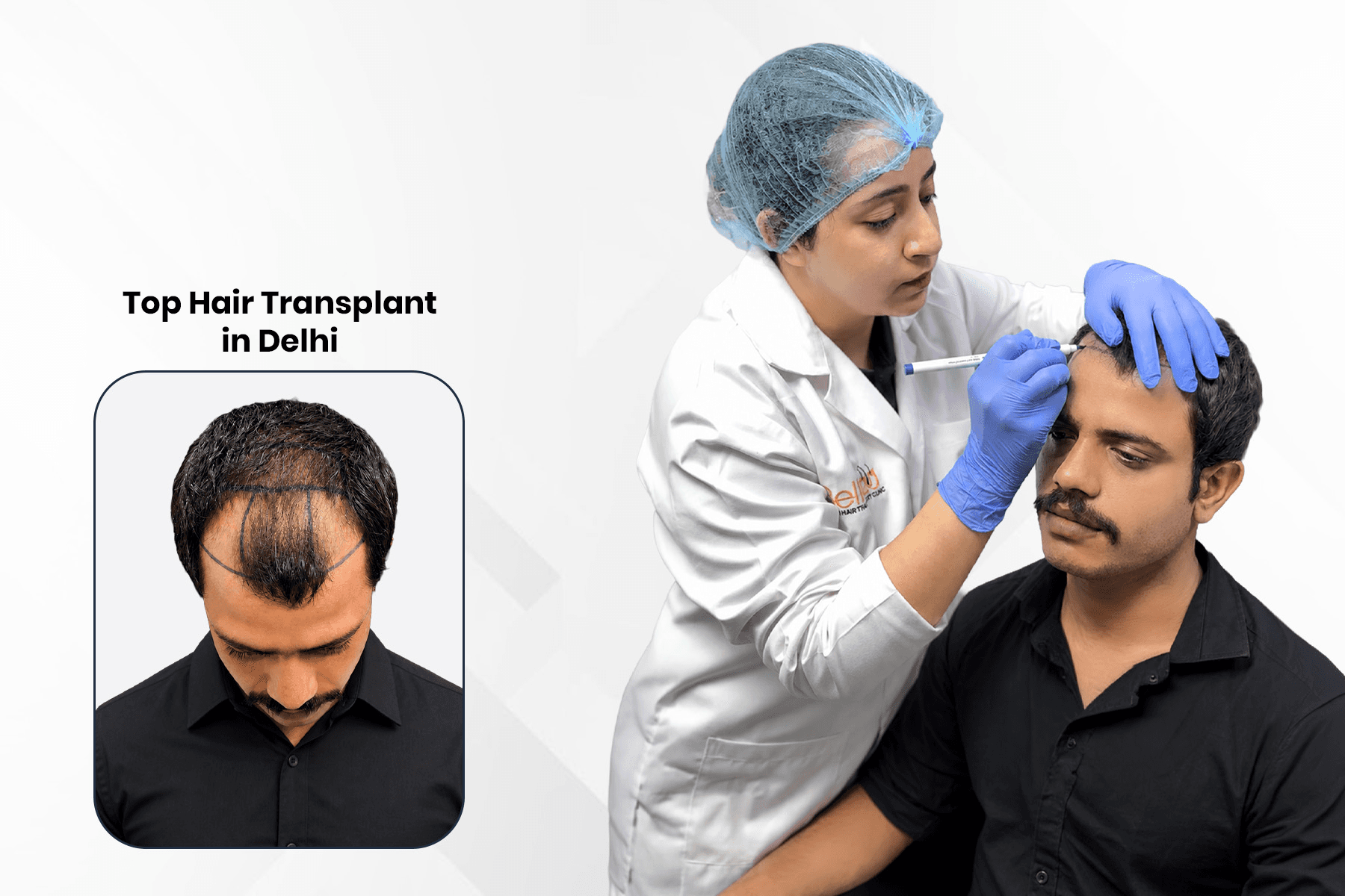 Best Hair Transplant Clinic in Delhi | DHI, FUE & PRP Treatment