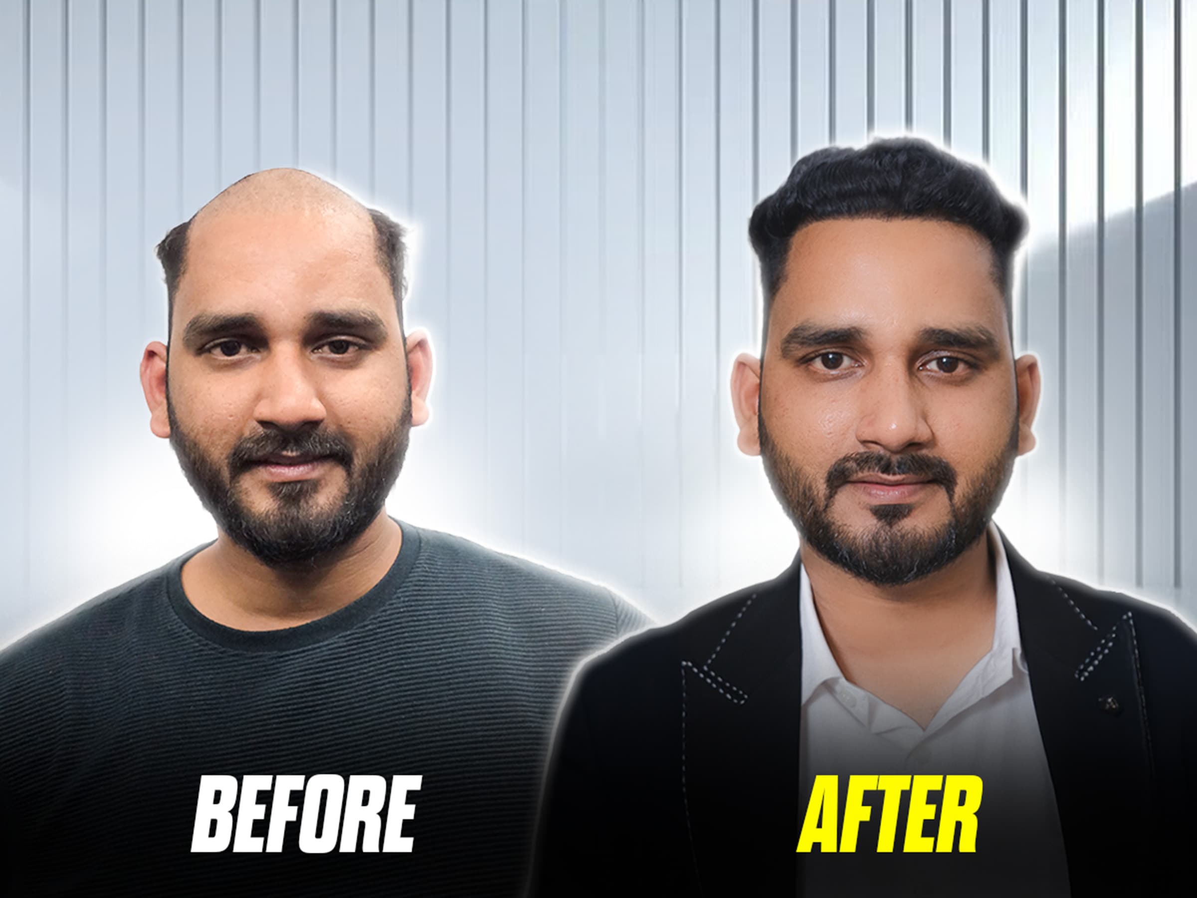 Vishal’s impressive hair transplant transformation.