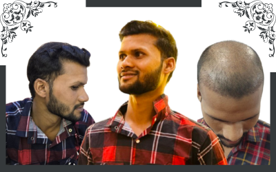 hair transplant results